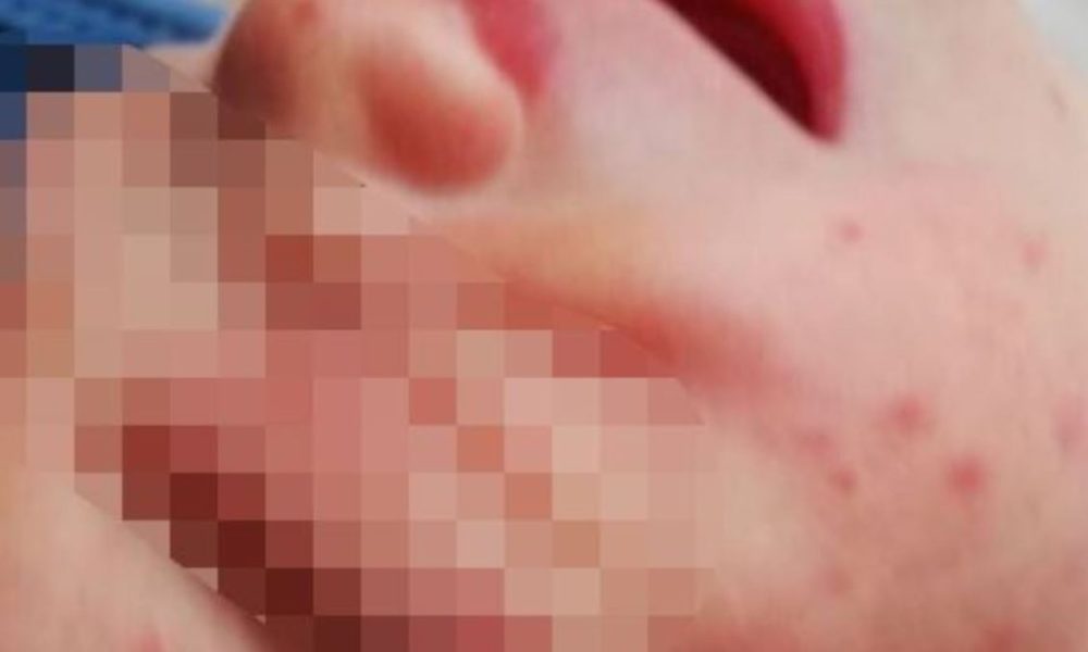 punture-zanzare-ospedale